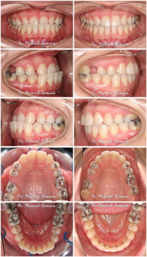 Mordida Cruzada Anterior Completa Invisible Invisalign Dr Manuel Roman