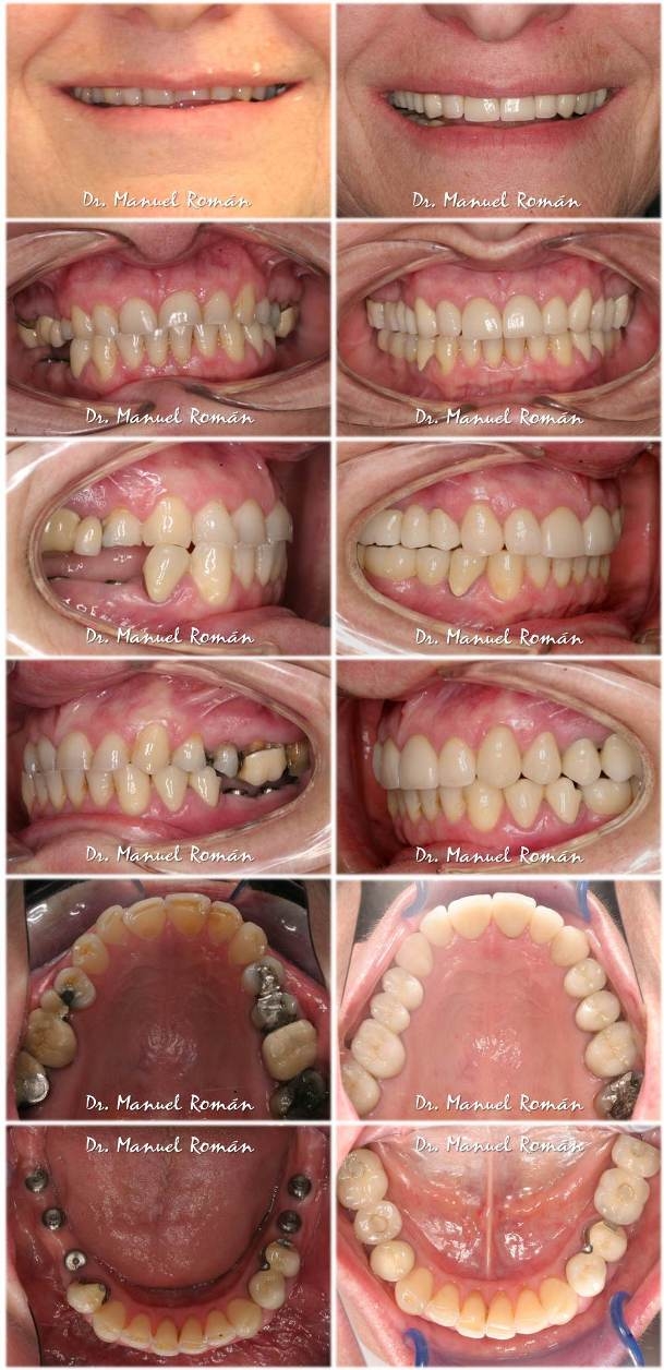 Invisalign - Clínica G7 Implantes