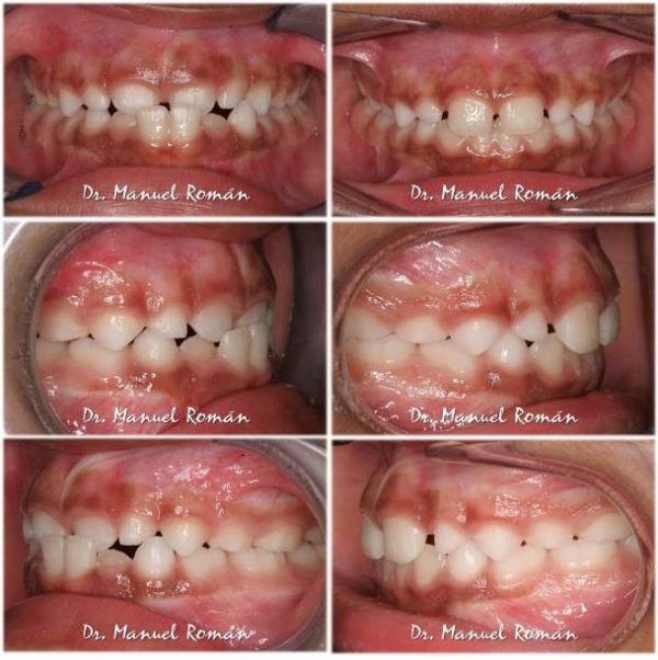 Mordida Cruzada Anterior En Un Ni O Invisible Invisalign