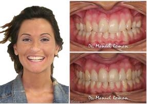 invisalign antes y despues de la mordida