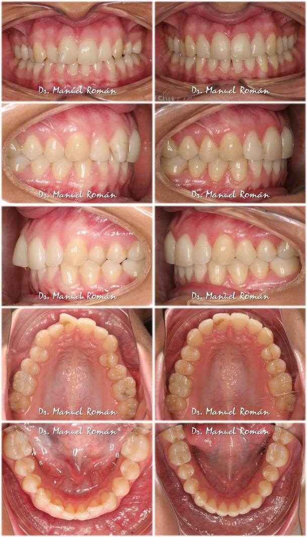 invisalign antes y despues de la mordida