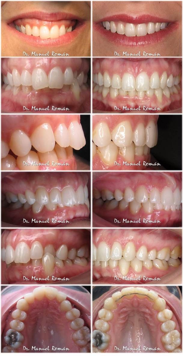 Mordida Cruzada Con Ortodoncia Lingual Invisible Invisalign Dr Manuel Roman